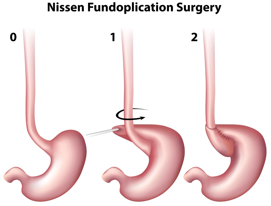 Nissen Fundoplication Surgery - Anti-reflux surgery