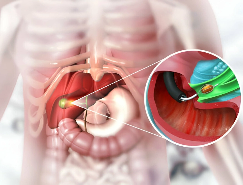 Gallbladder - Gallstone Surgery