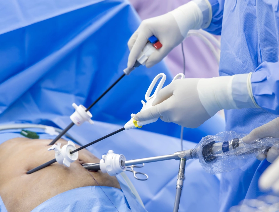 Gallbladder Surgery by Dr. Sherif Awad