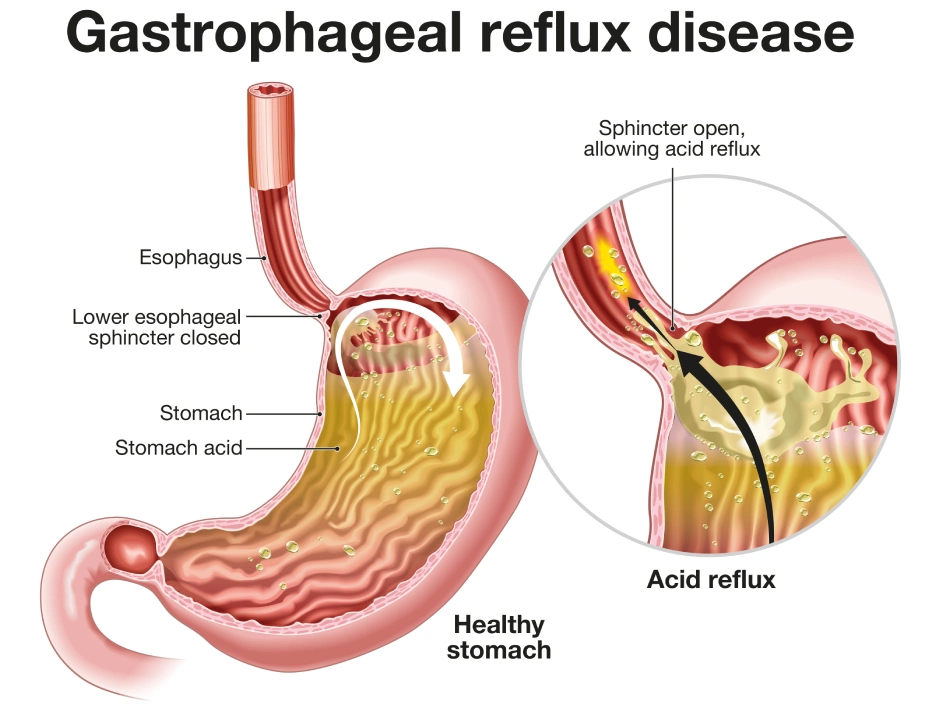 Gastrophageal Reflux Disease