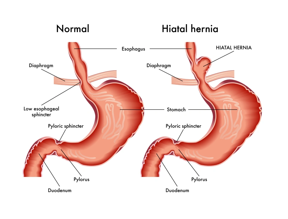 Hiatal Hernia - Explained