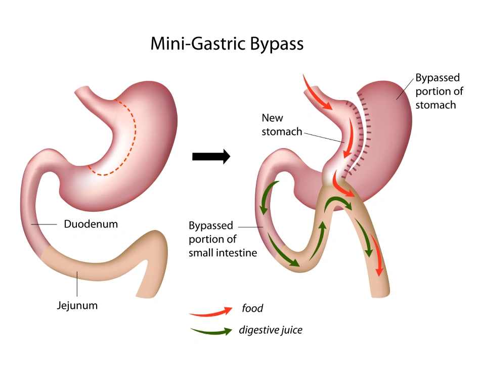 Mini Gastric Bypass - Explained